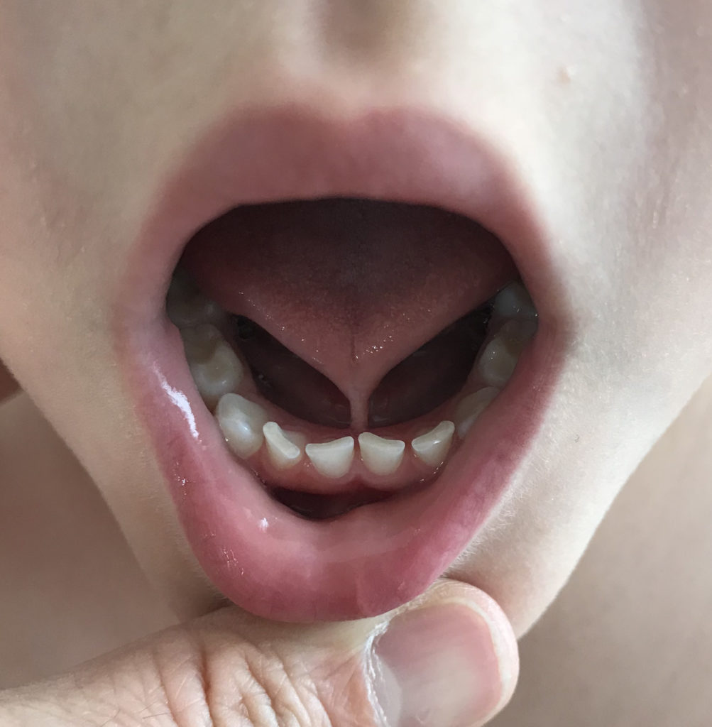 tongue ties