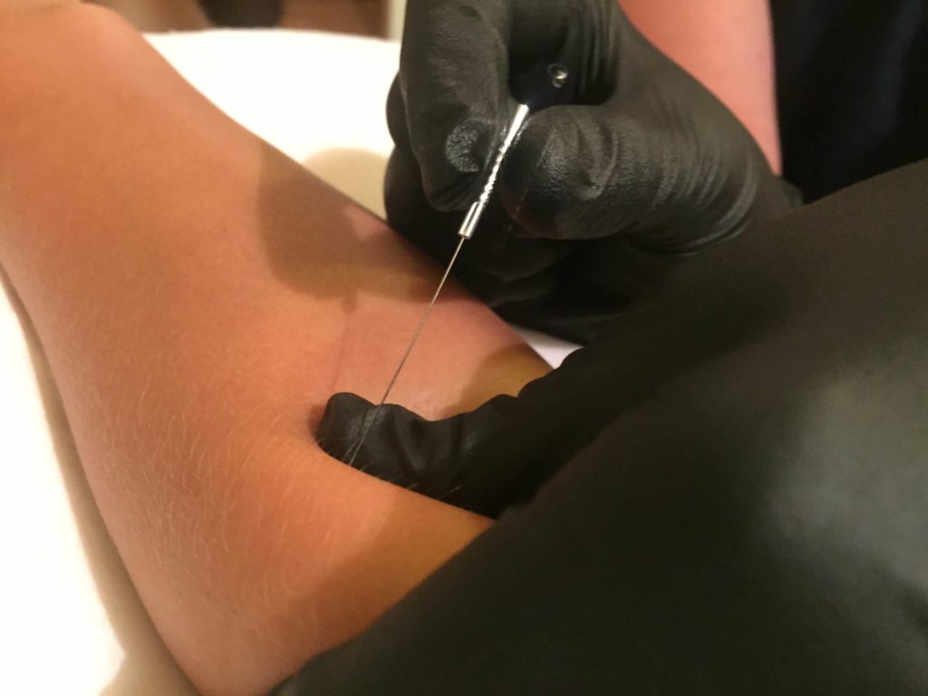 dry needling