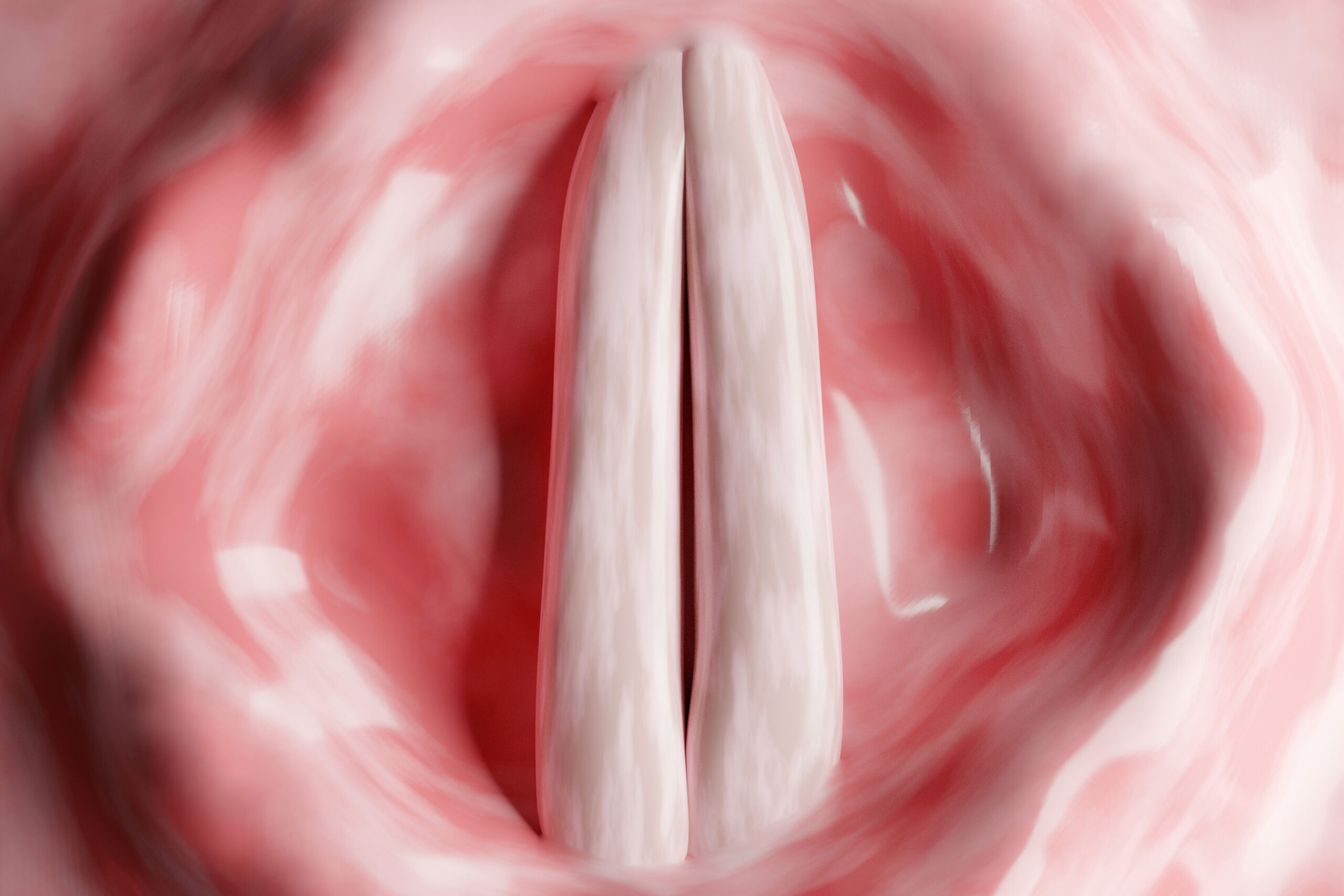 Paradoxical Vocal Fold Movement How Can Speech Therapy Help?