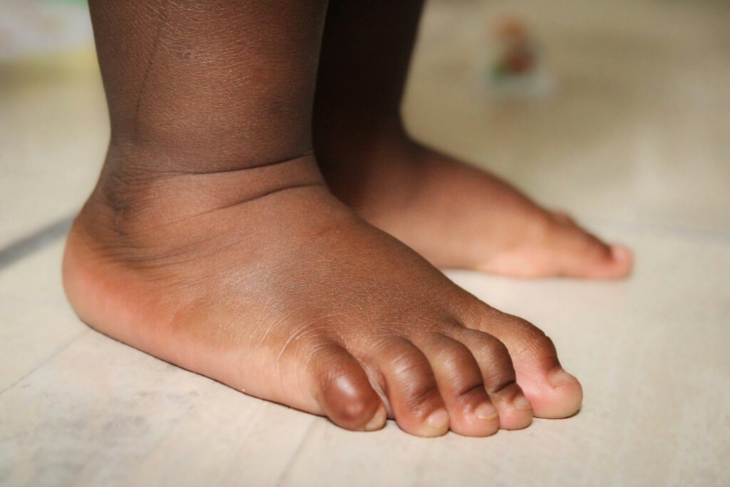flat feet